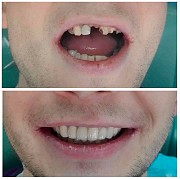 Професійне протезування зубів у Черкасах - знижка для пенсіонерів Черкассы